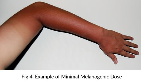 Example of Minimal Melanogenic Dose