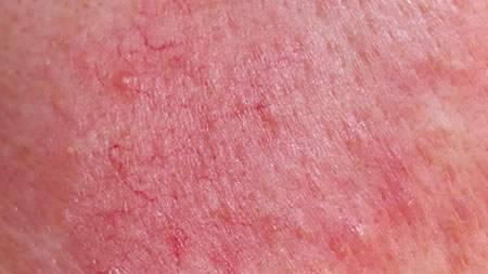 Rosacea: Triggers and Subtype Classification