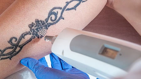 Laser Tattoo & Benign Pigmented Blemish Removal – Level 4 & 5