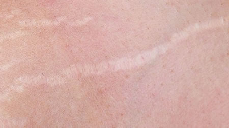 skin scar tissue