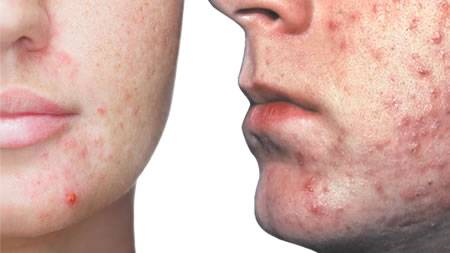 Acne: Physiology and Analysis